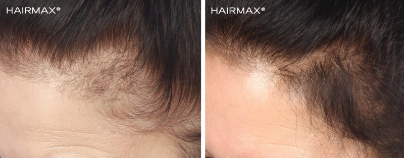 Lazerinis plaukų lankelis HairMax Laser Band 41 G, LASERBAND, skatina plaukų augimą