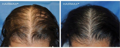 Лазерная расческа для волос HairMax Laser Comb Ultima 12, LASERCOMB, стимулирует рост волос