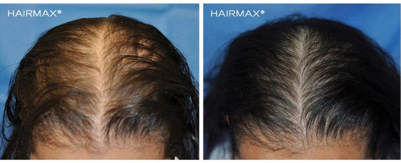 Lazerinės plaukų šukos HairMax Laser Comb Ultima 12, LASERCOMB, skatina plaukų augimą