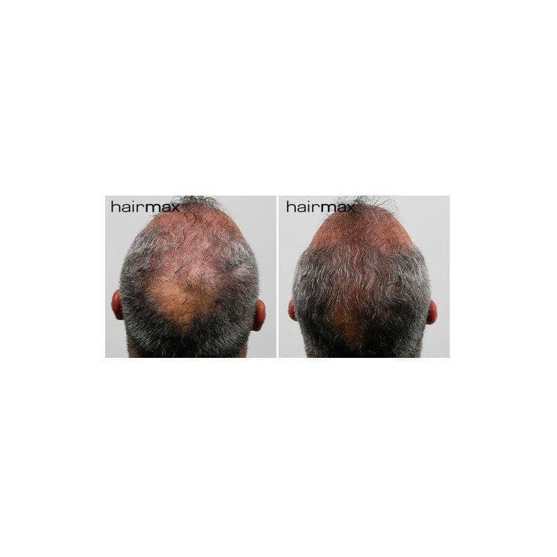 Lazerinė kepuraitė plaukams HairMax Laser Cap 202 Black, LASERCAP202, skatinanti plaukų augimą