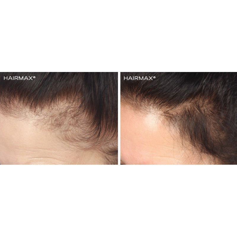 Laser hair band HairMax Laser Band 82 ComfortFlex HMLB82CF, promotes hair growth