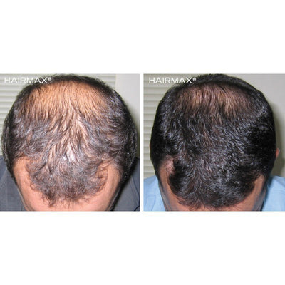 Laser hair band HairMax Laser Band 82 ComfortFlex HMLB82CF, promotes hair growth