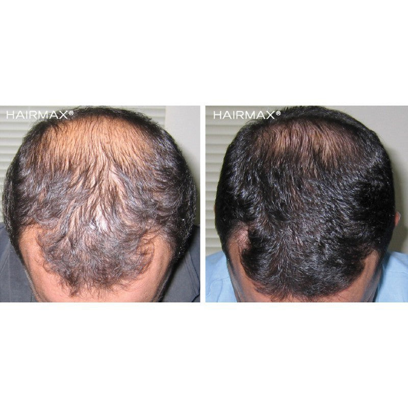 Lazerinis plaukų lankelis HairMax Laser Band 82 ComfortFlex HMLB82CF, skatina plaukų augimą